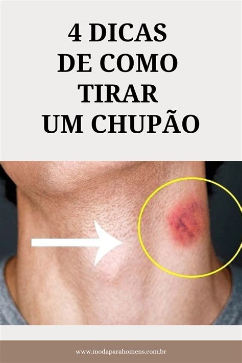 como titar chupao|Como Se Livrar de Um Chupão Da Noite pro Dia: 9 Passos